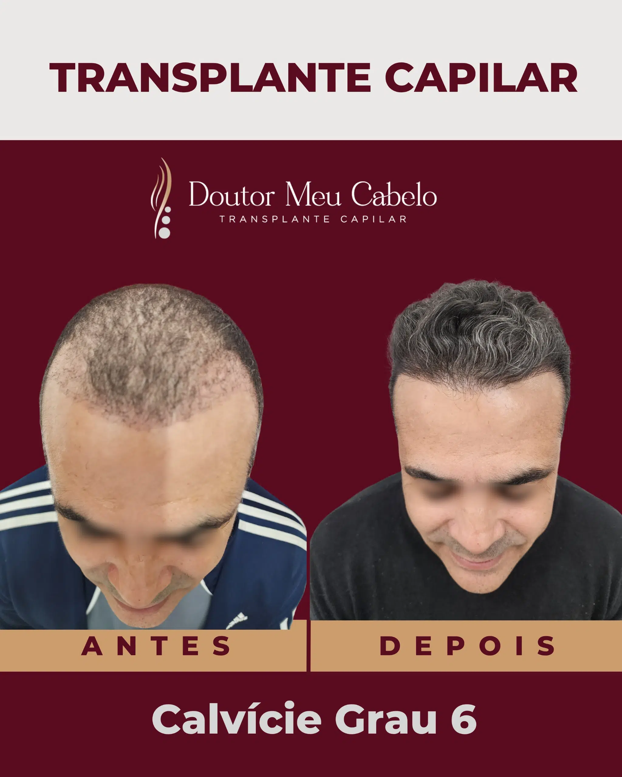antesedepois1