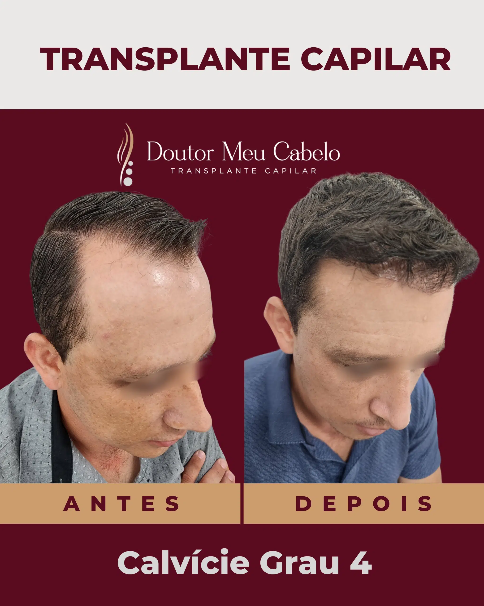 antesedepois2