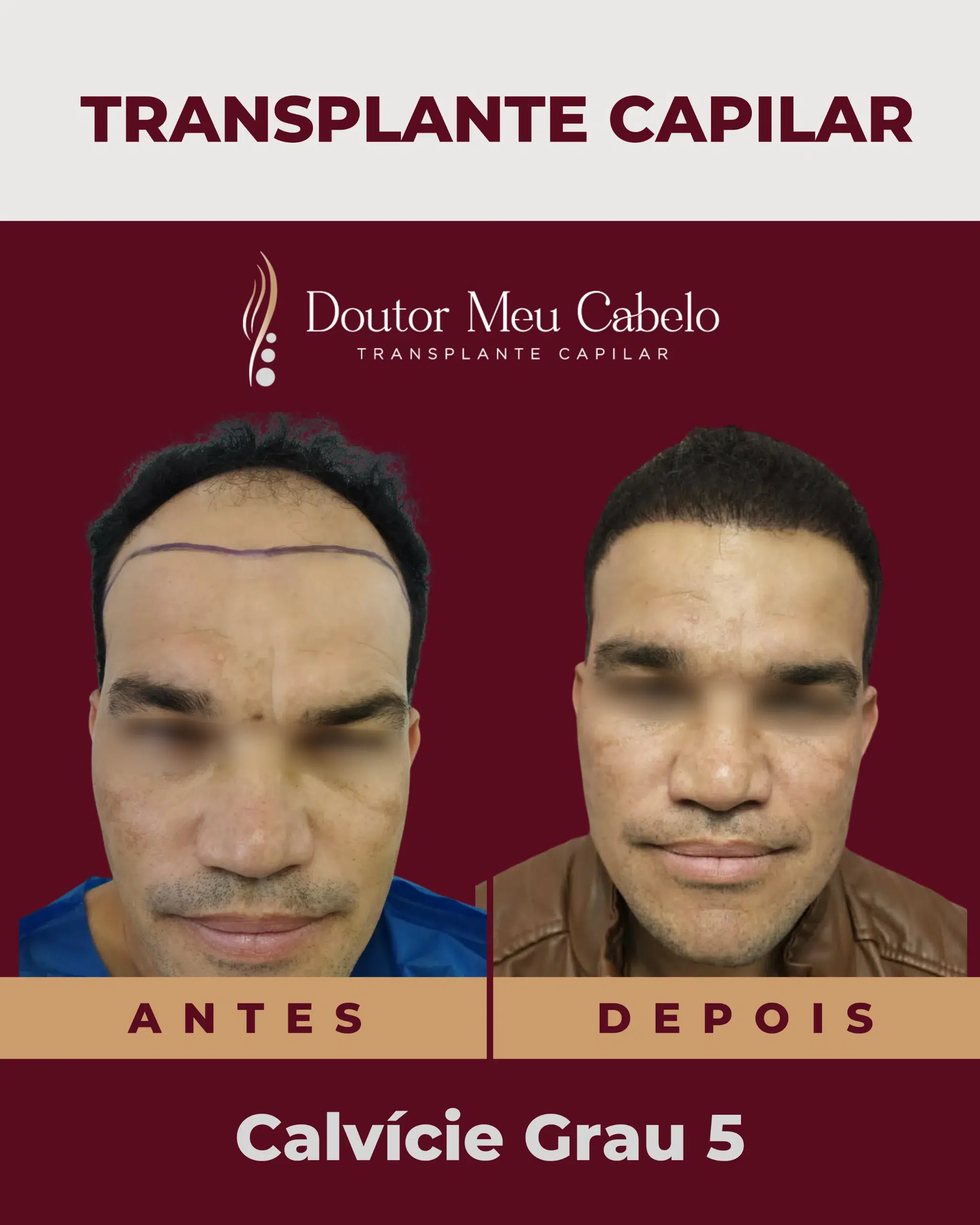 antesedepois3
