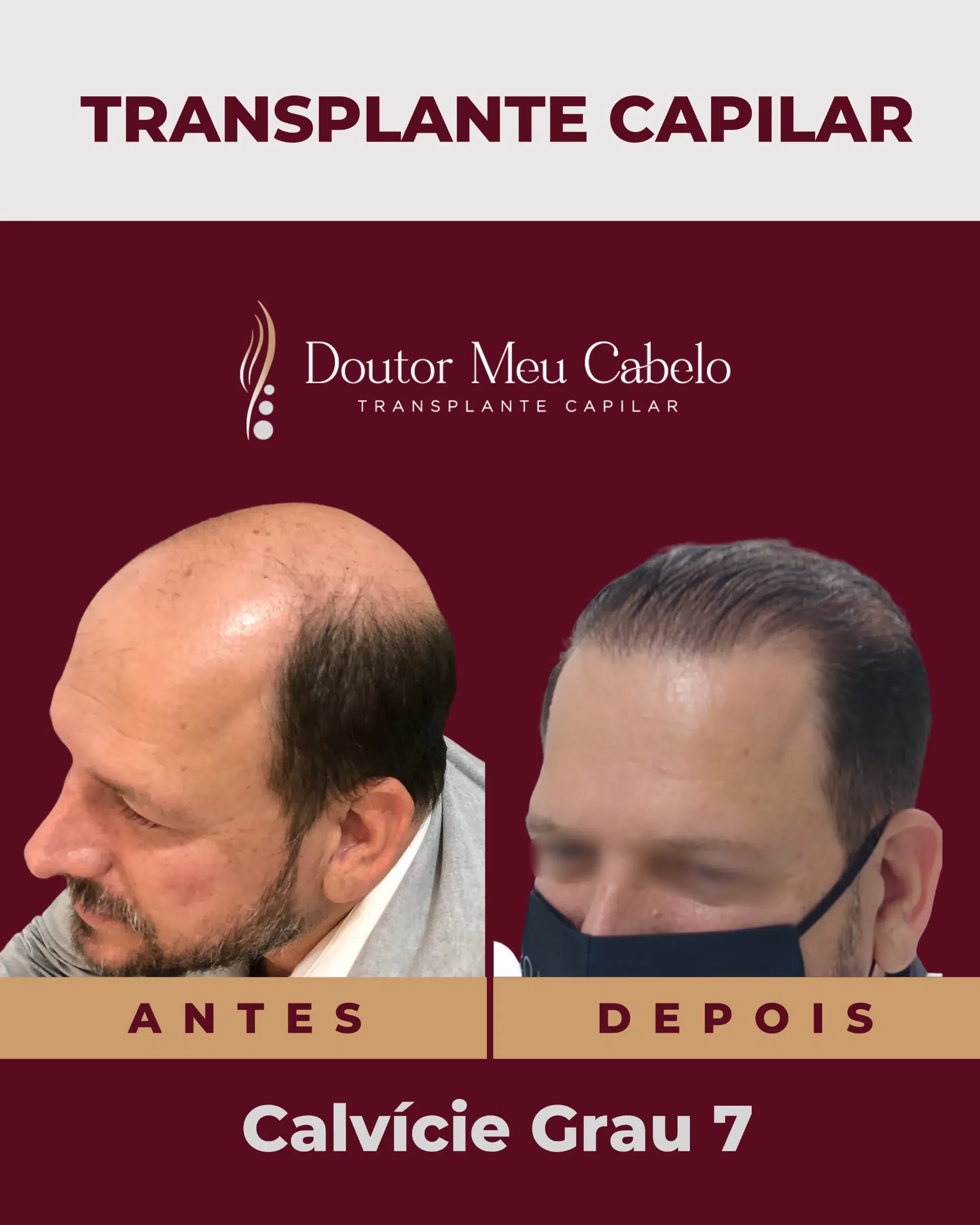 antesedepois4